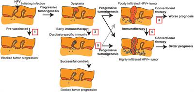 Development and therapeutic manipulation of the head and neck cancer tumor environment to improve clinical outcomes